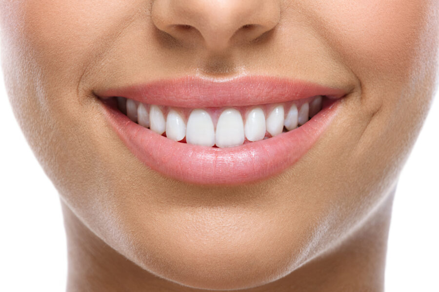 ¡Todo sobre las carillas dentales!