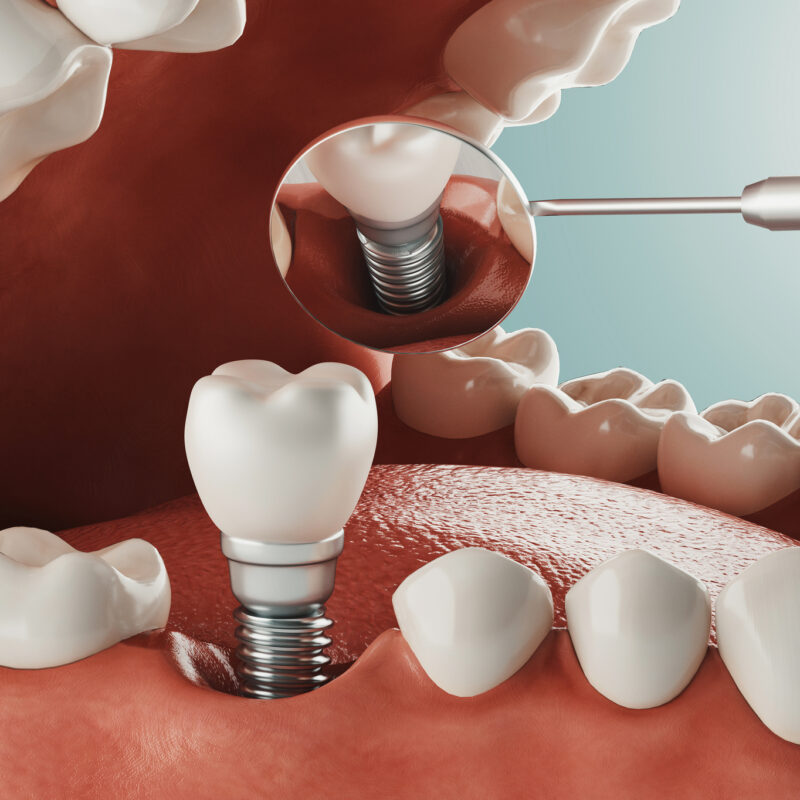 Tipos de implantes dentales y su colocación