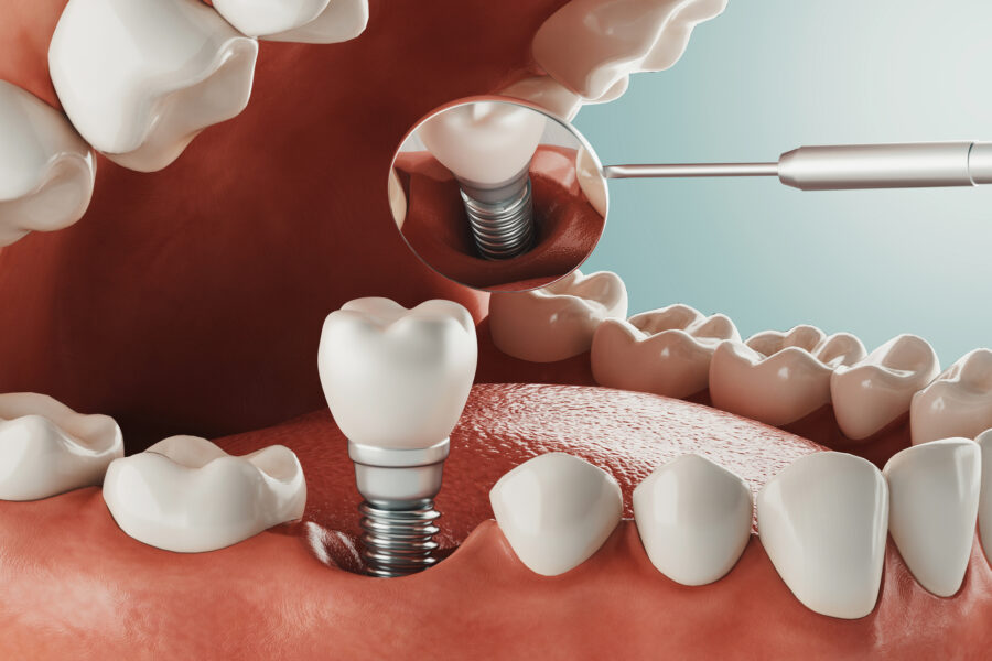 Tipos de implantes dentales y su colocación