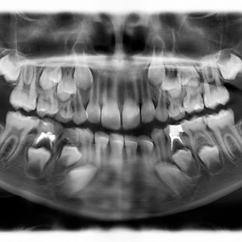 Dientes incluidos