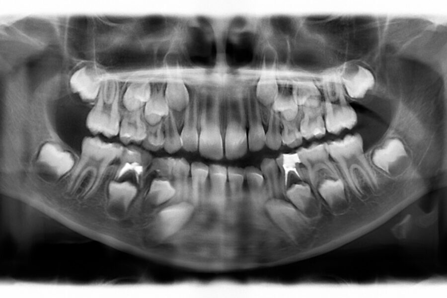 Dientes incluidos