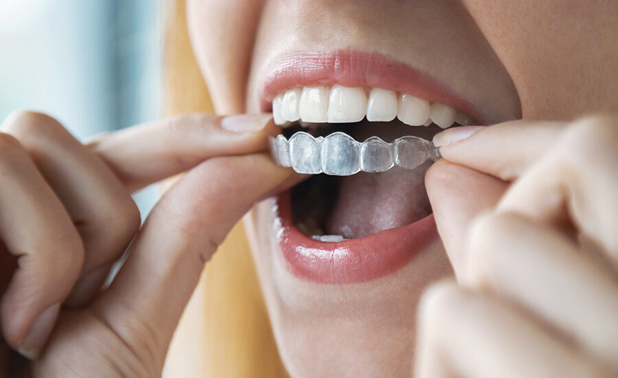 braces