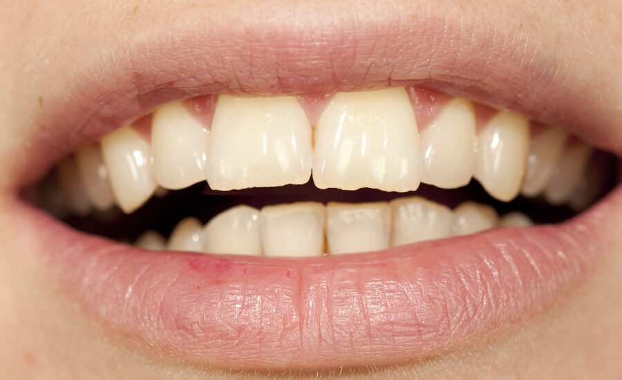 braces