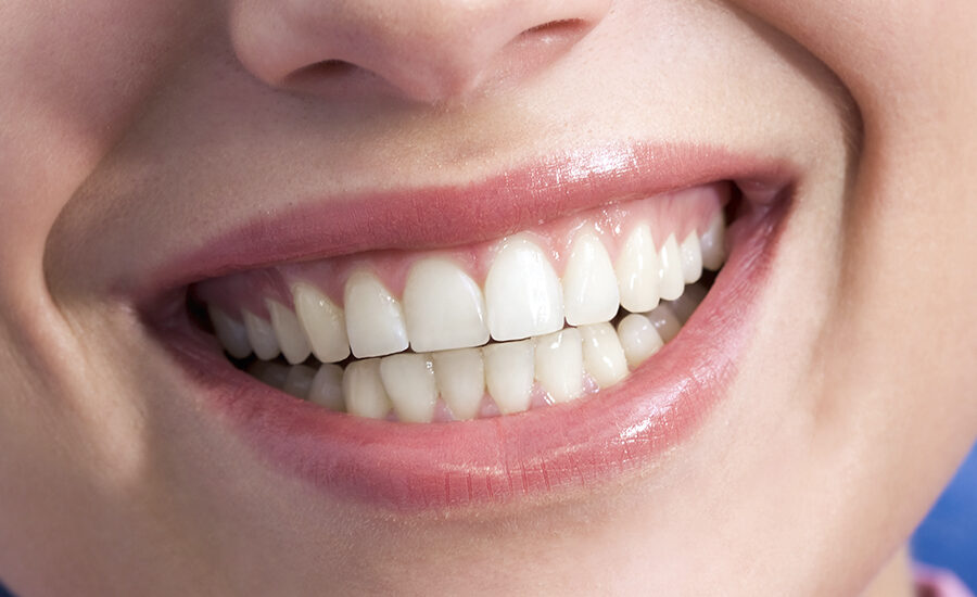 braces