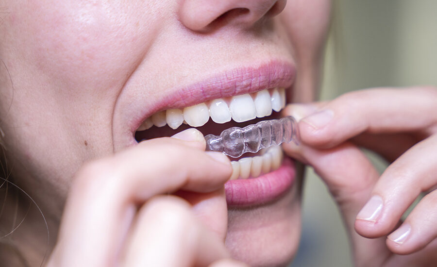 braces